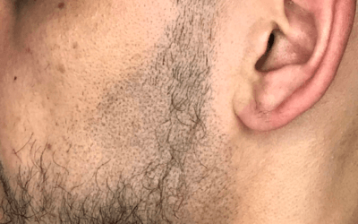 Facial Micropigmentatie (FMP); een variant op Micro Haar Pigmentatie