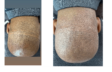 Blog 15 What solutions can Scalp Micropigmentation offer?