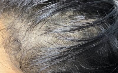 Wat is Micro Haarpigmentatie MHP