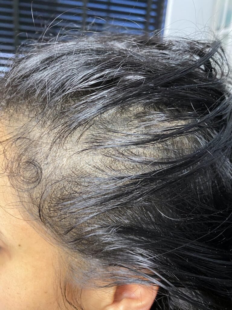 Wat is Micro Haar Pigmentatie MHP