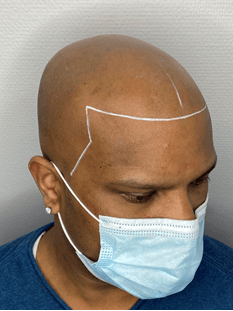 Choose your own hair contour with Scalp Micropigmentation 2
