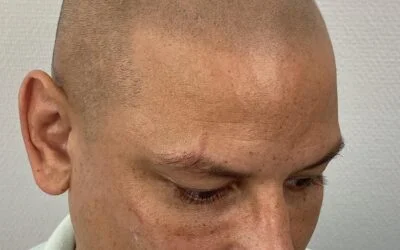 Het resultaat van Micro Haar Pigmentatie; permanent of niet…?