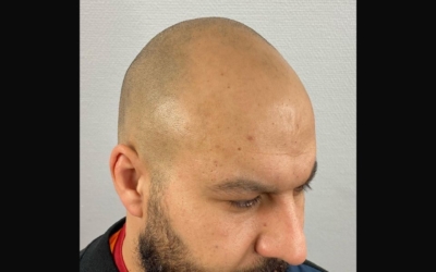 Micro Haar Pigmentatie; oplossing voor een teruggetrokken haarlijn of zijprofiel