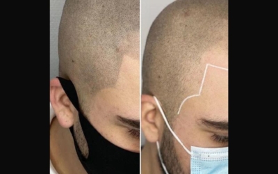 Een complete haarlijn en bakkebaard met Micro Shading