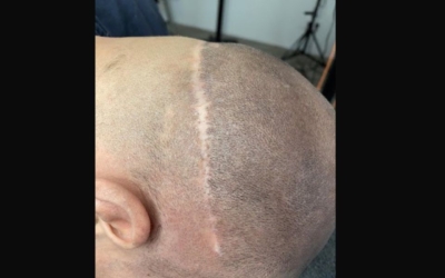 Combinatie Haartransplantatie en Micro Haar Pigmentatie